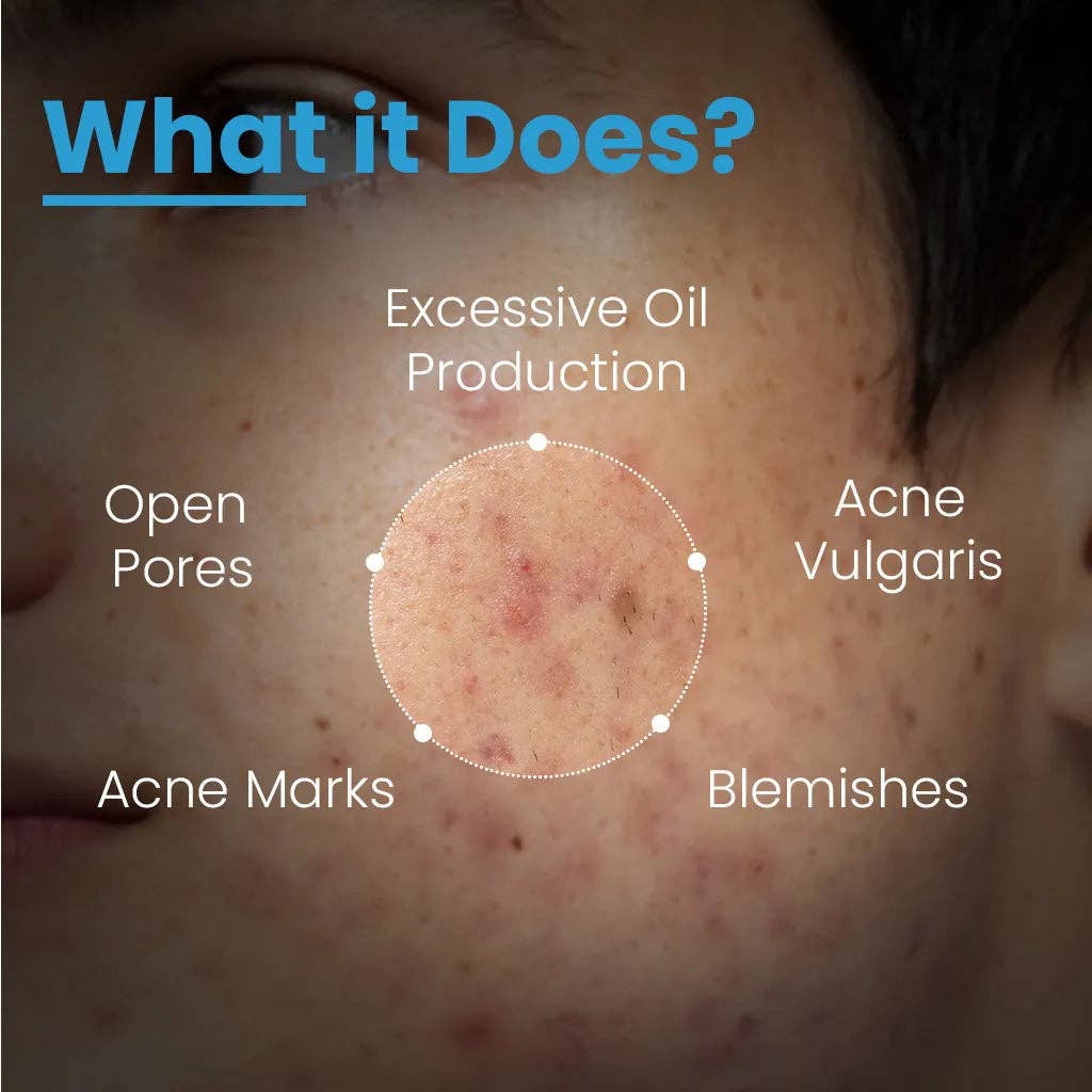FCL Alpha Beta Acne Gel | 30 ml | Salicylic & Glycolic Acid – Clears Breakouts & Unclogs Pores